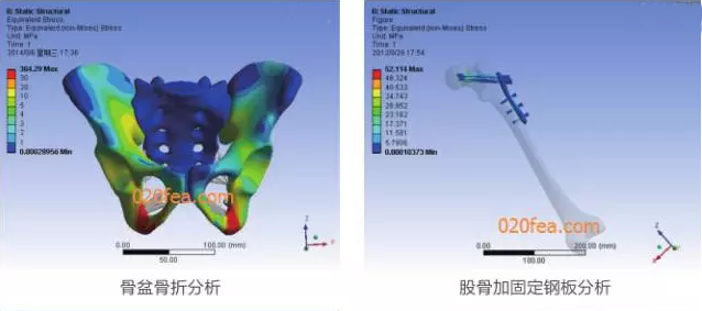有限元分析法在結(jié)構(gòu)、醫(yī)學(xué)、流體與熱及電場(chǎng)的分析與應(yīng)用